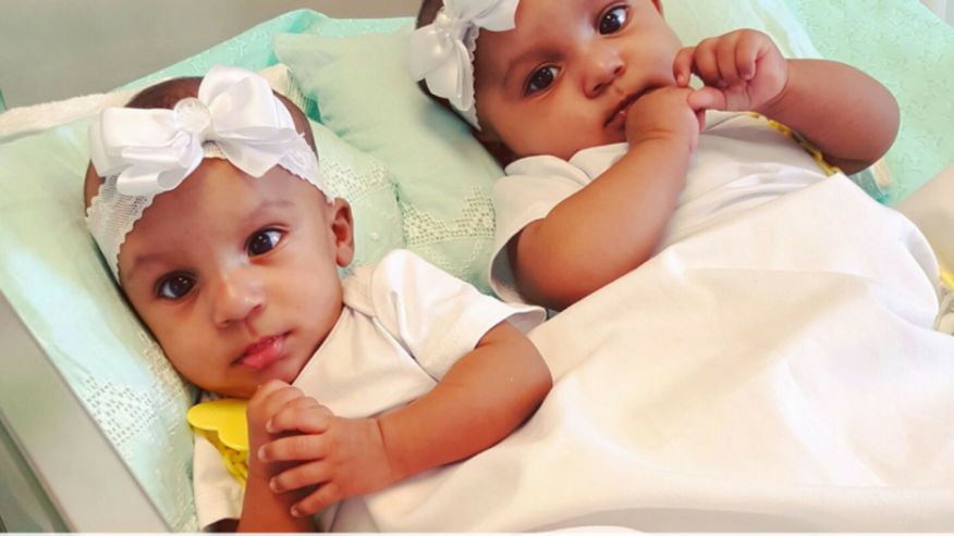 Conjoined twins separated after marathon 21-hour surgery  fxn.ws/2ksDy5w via <a href="/foxnewshealth/">Fox News Health</a>