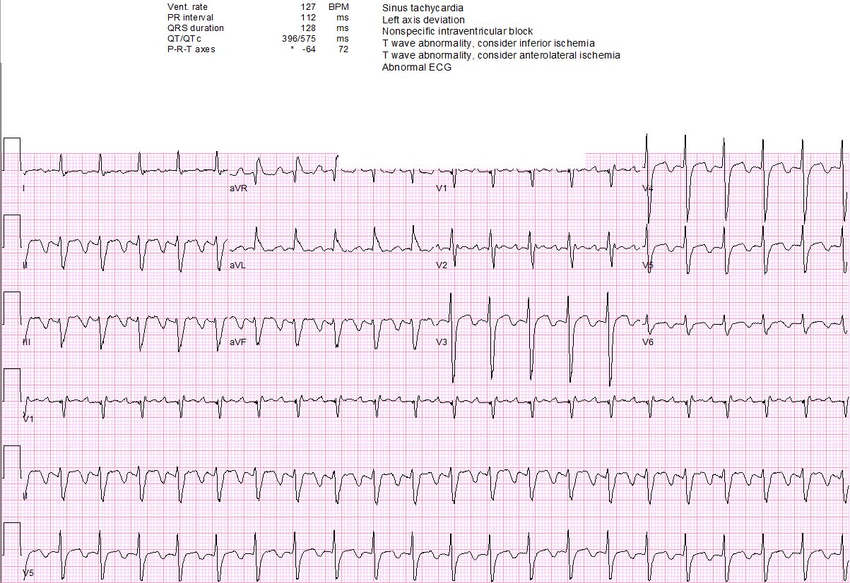 Jk Han Md Second Referral Today For Persistent Sinus Tach Still Not Sinus Tachycardia Always Compare To Baseline If Available Cardioed Foamed T Co Lvjkki11mf Jk Han Md Second Referral Today For Persistent Sinus Tach Still Not Sinus Tachycardia Always Compare To Baseline If Available Cardioed Foamed T Co Lvjkki11mf