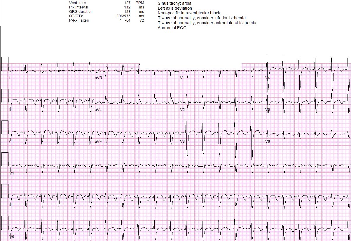 Jk Han Md Second Referral Today For Persistent Sinus Tach Still Not Sinus Tachycardia Always Compare To Baseline If Available Cardioed Foamed T Co Lvjkki11mf