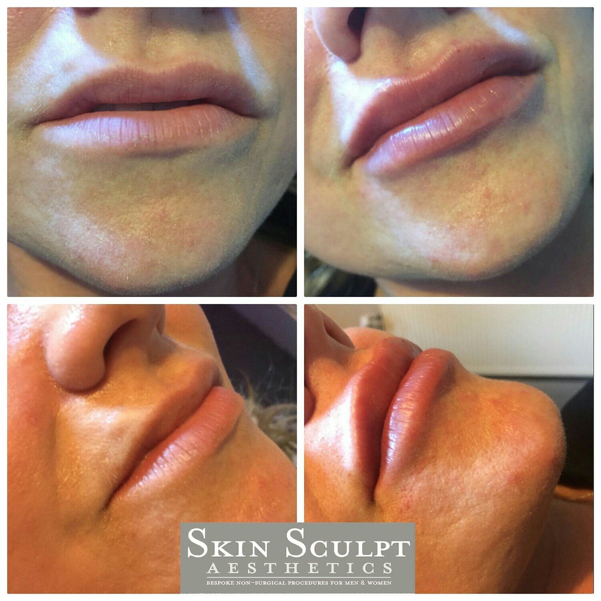 SkinSculpt's tweet photo. I ❤ working with a needle ✌I have client lip envy  #SkinSculptAesthetics #CupidsBow #Lips https://t.co/bTMWbPLTlk