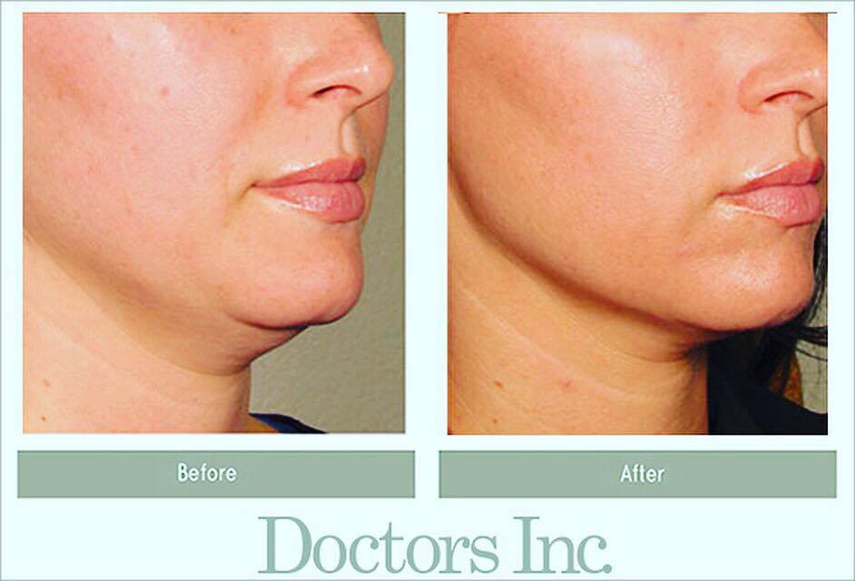 Wish to have a younger&amp;tighter neck/jawline? #Ultherapy lifts&amp;tightens your skin in a non-surgical way. Learn more: bit.ly/21ovg9Q