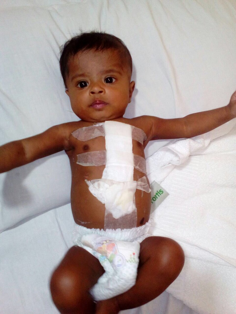 offl_Lawrence's tweet photo. Vishwa has now been successfully operated and is doing good now. This is our 132nd open heart surgery. Thanks all
https://t.co/D5uzG7TT7o https://t.co/6yB7S5rYOh
