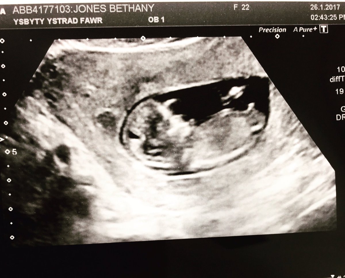 Szpadtsy's tweet photo. The secret can finally be announced! Me and @bethyjonesx are expecting a baby 👶 We are both over the moon! #baby #12weekscan #scanphoto https://t.co/wfgMrGWFHS