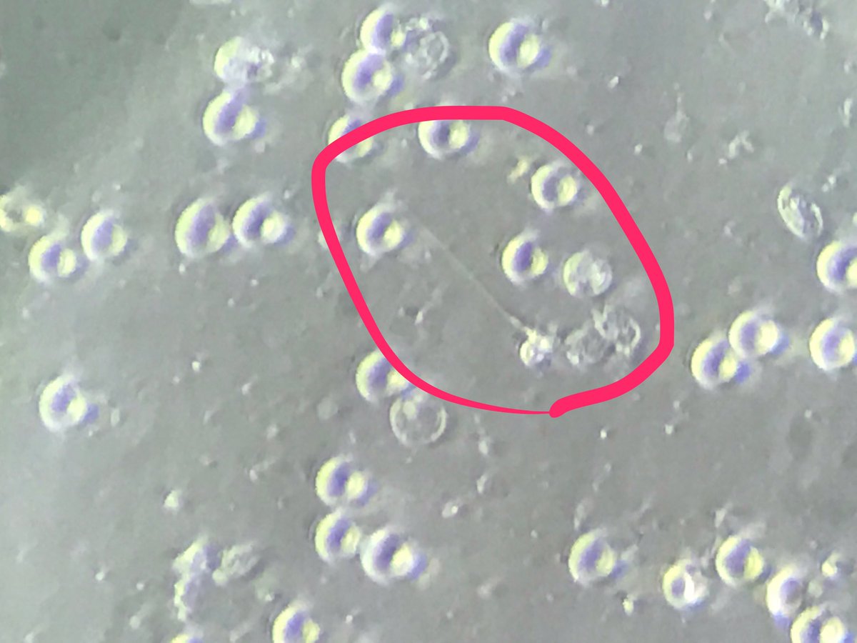 Where's Waldo the sperm?  MicroTESE is really life changing for patients.  This found on hour 3 of looking. Nice to get kid pics every week