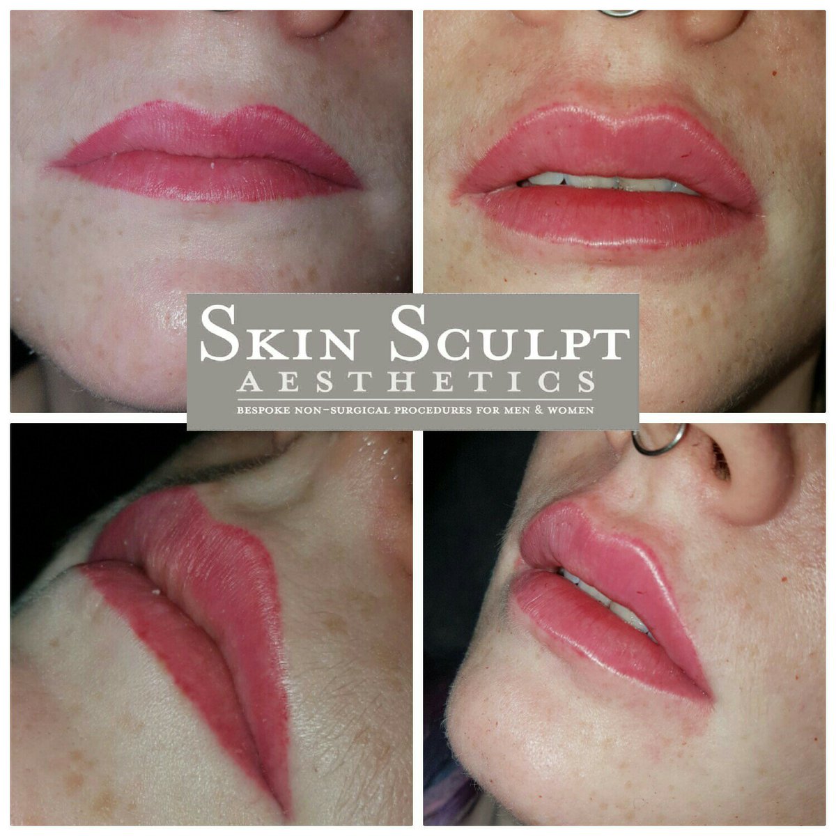 SkinSculpt's tweet photo. 💉 #precisiondetailing #Lips 💋 https://t.co/XHLCBdPXZ7