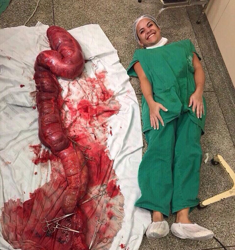 The Bridge نادي الجسر on Twitter &quot;Toxic megacolon is the clinical