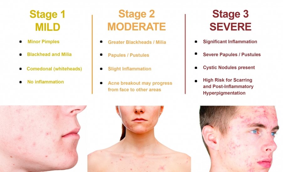 ClinInk_info's tweet photo. Three main stages of acne! Don’t feel good with your acne then book an appointment with myself 07580446139. From £45 per session! https://t.co/WHLtZs9ZLQ