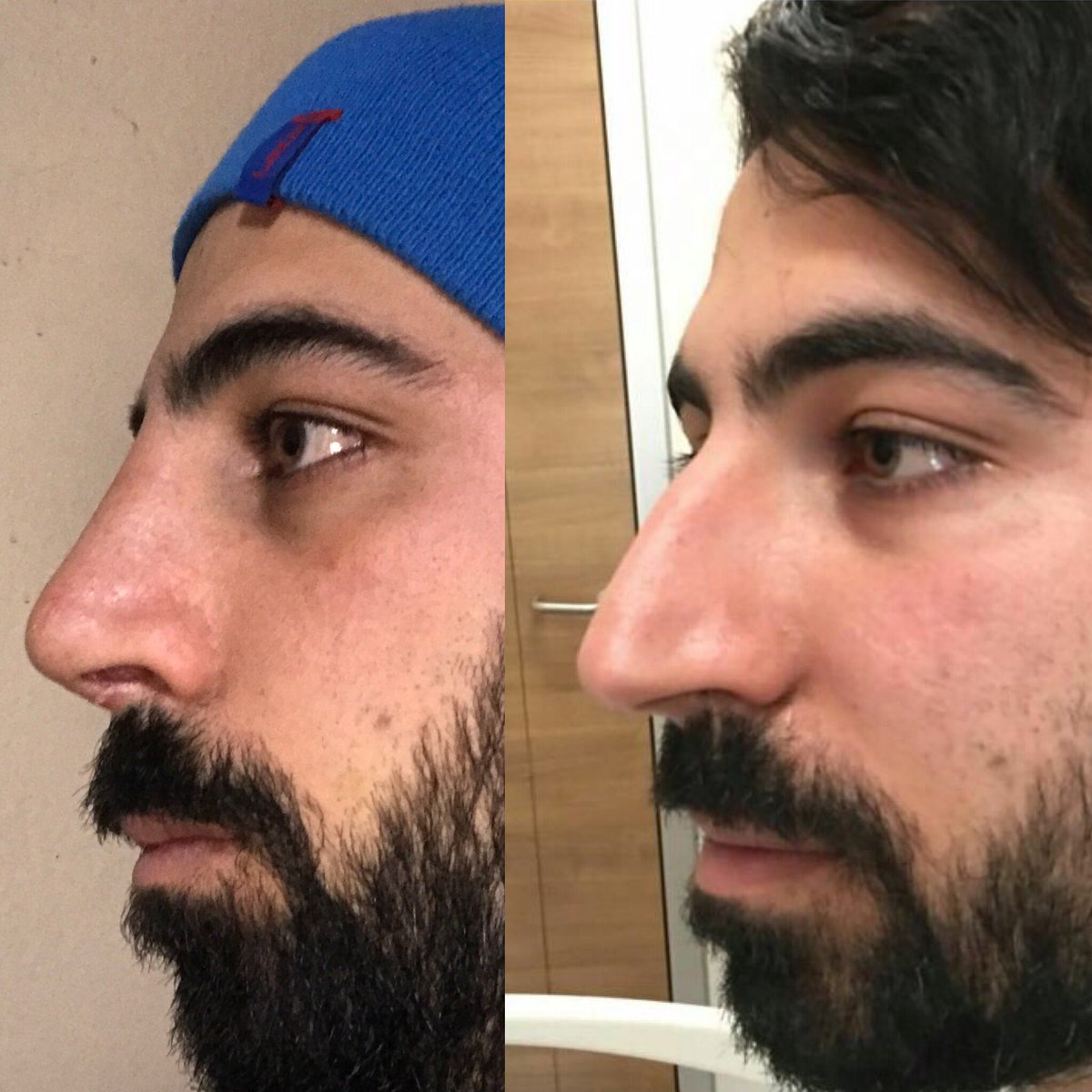 murat23celik's tweet photo. Evet Ameliyatın 10. Günü Ve son Durum bu %100 fark var.
Doktorum @Dr_OrhanAlan'ı bu güzel iş için bir kez daha tebrik ediyorum mukemmelsiniz https://t.co/An6FmSdN9T