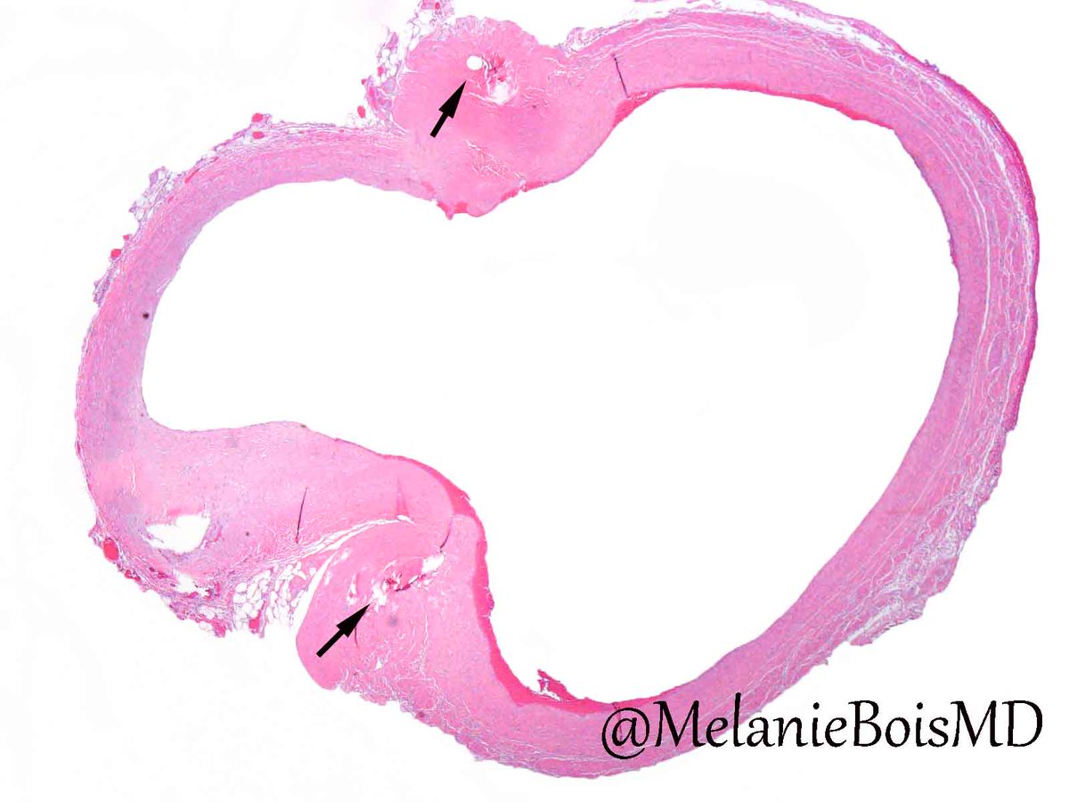 MelanieBoisMD's tweet photo. Coronary artery bypass graft on H&E, elastic stain. Arrows=Anastomosis. Native coronary artery (L), vein graft (R). #MayoCVPath #cardiacpath https://t.co/fvOCUEWUmV
