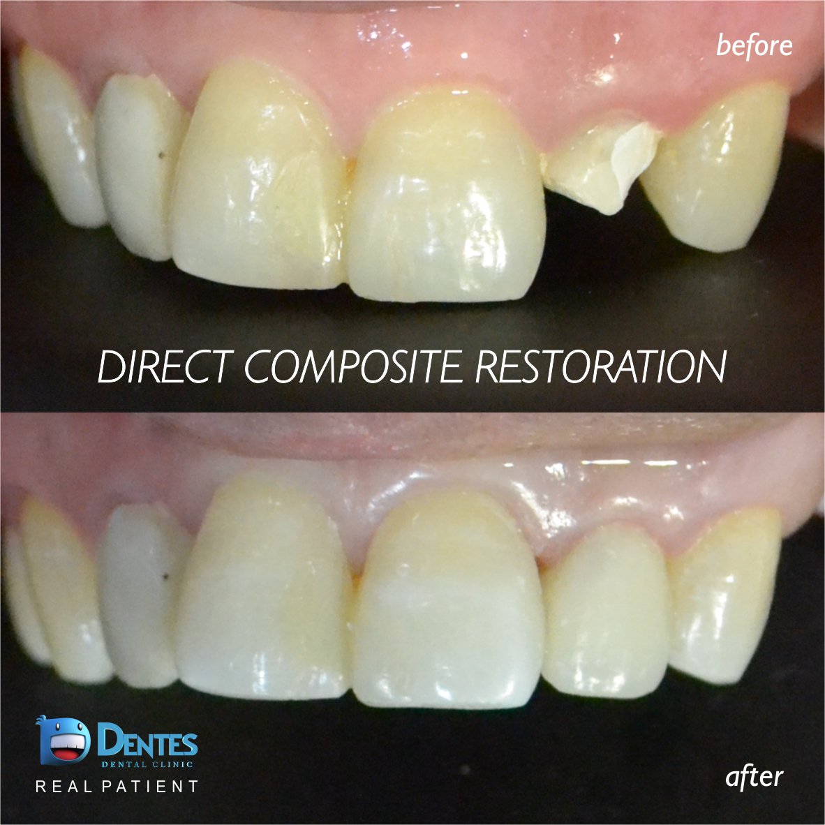 klinikdentes's tweet image. Hasil Tambalan Gigi Depan dengan Komposit
#directcomposite #tambalgigi #tambalgigidepan