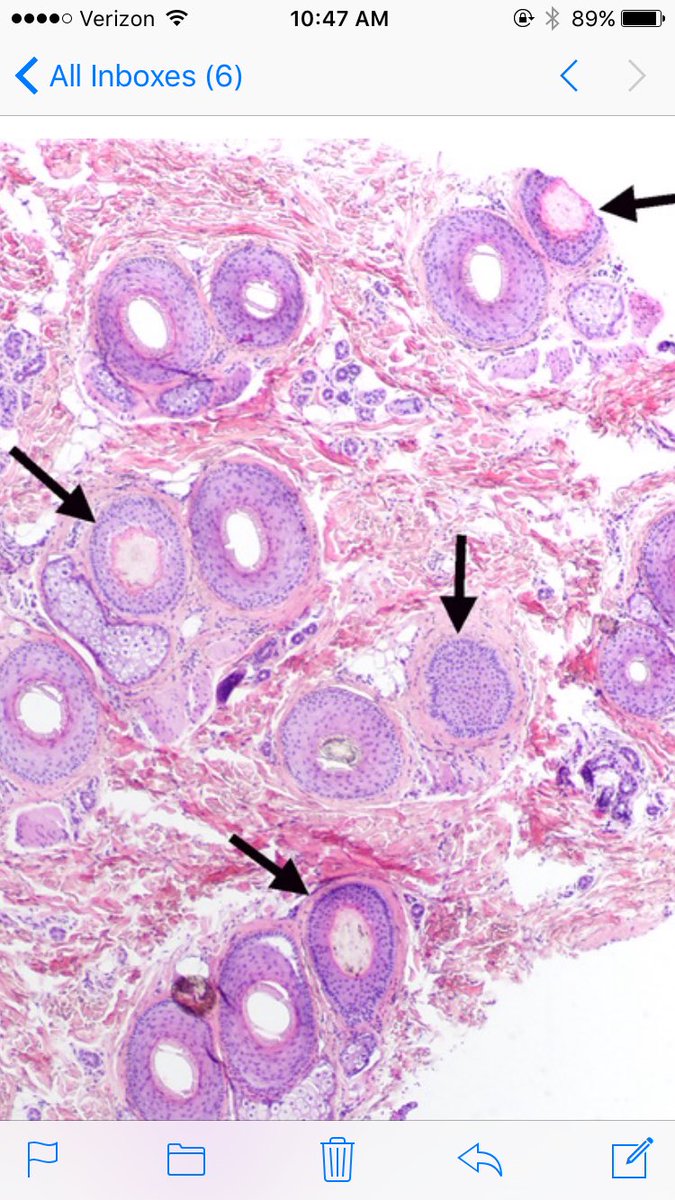 LenSperling's tweet image. Telogen count based on TERMINAL HAIRS. Need to count at multiple levels. Here 4/21 terminal hairs in telogen,so count is 19%