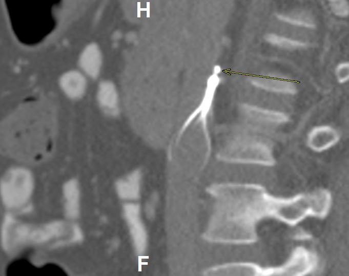 MountSinaiIR's tweet photo. LIVE @MountSinaiNYC #IRad: #transfemoral assist #transjugular graspers #FILTEROUT Celect #hookoutsidethewall #GTFO @bonesz @SIRspecialists https://t.co/VSz6CnahD2