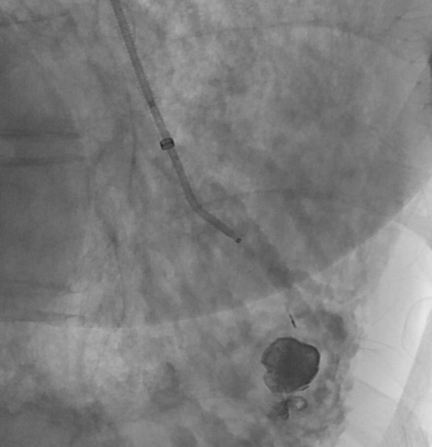 TheRealDoctorOs's tweet photo. Looks like my Twitter crew is rubbing off on me, s/p Onyx and MVP embo of Pulm Arterial PSA, thx guys! #irad #justOnyxIt #liquidEmbolics https://t.co/1nYwUyp0vQ