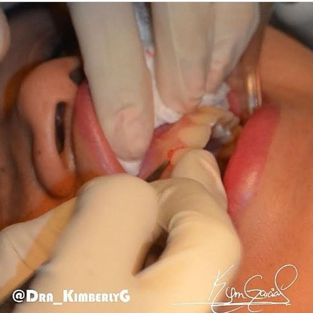 Gingivectomia estética, mejor conocido como Recorte Gingival 
Este recorte se hace en pacientes que muestran mucha encía al sonreír.