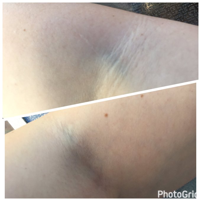 @BobbiDylanXXX top is arm I never get drawn from.. bottom you can't even see my main vein anymore. Still<a class="tags" target="_blank" title="On Twitter" href="/?out=eyJ0eXAiOiJKV1QiLCJhbGciOiJIUzUxMiJ9.eyJpYXQiOjE3MjE1ODk5NzksImlzcyI6InR3cG9ybnN0YXJzLmNvbSIsIm5iZiI6MTcyMTU4OTk3OSwiZXhwIjoxNzUzMTI1OTc5LCJyZWRpcmVjdF91cmwiOiJodHRwczovL3R3aXR0ZXIuY29tL0JvYmJpRHlsYW5YWFgifQ.SDYokLOMA7H0dbRUtyIL-yhfMaNW7aLBLBspk7jHfoPIdiqkdpwlIw6Jp6ijDRxp9wXy1vkBvE4cwMspdS2xRg">@BobbiDylanXXX</a><a href="/tag/bbwcon"class="tags"><span>#bbwcon</span></a>