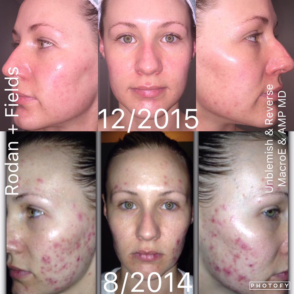 RFLookinGood's tweet photo. Dealing with #acne? #acnescars? #skincare #RFLookinGood  https://t.co/4hog9xIhmU https://t.co/TOukiu2USi