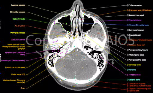 Bones of cranium - e-Anatomy - IMAIOS