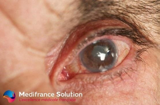 medifrasolution's tweet photo. Still don't know about the cataract? - Read here! 
https://t.co/T2GGkkZuut
#medifrancesolution https://t.co/RBcTCWLrNO