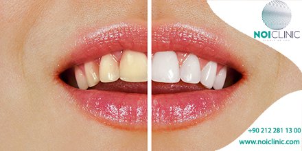 Gülümsemekten çekinmeyin, #DişBeyazlatma uygulamamız ile sağlıklı ve güzel bir gülüşe sahip olabilirsiniz. 0212 281 13 00