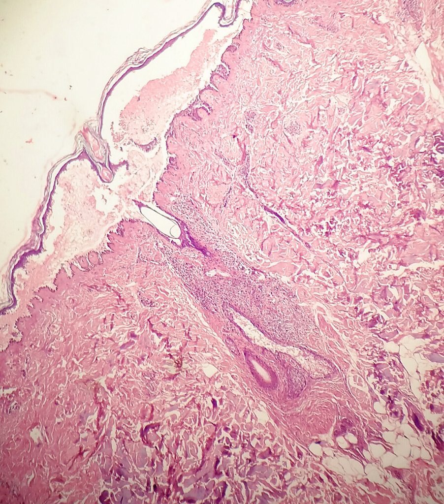 Rosapath's tweet image. Pemphigus vulgaris with classic row of tombstone and DIF showing IgG chicken wire pattern of ICS deposit