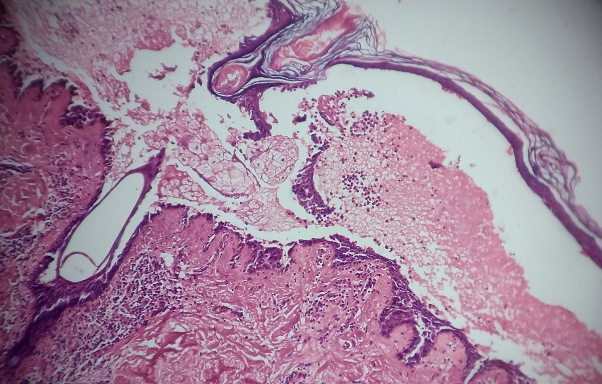 Rosapath's tweet image. Pemphigus vulgaris with classic row of tombstone and DIF showing IgG chicken wire pattern of ICS deposit