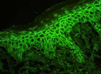 Rosapath's tweet image. Pemphigus vulgaris with classic row of tombstone and DIF showing IgG chicken wire pattern of ICS deposit