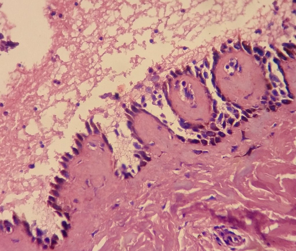 Rosapath's tweet image. Pemphigus vulgaris with classic row of tombstone and DIF showing IgG chicken wire pattern of ICS deposit