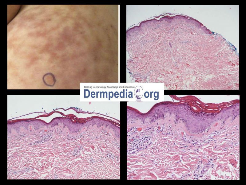 Dermpedia Courses on Twitter: 