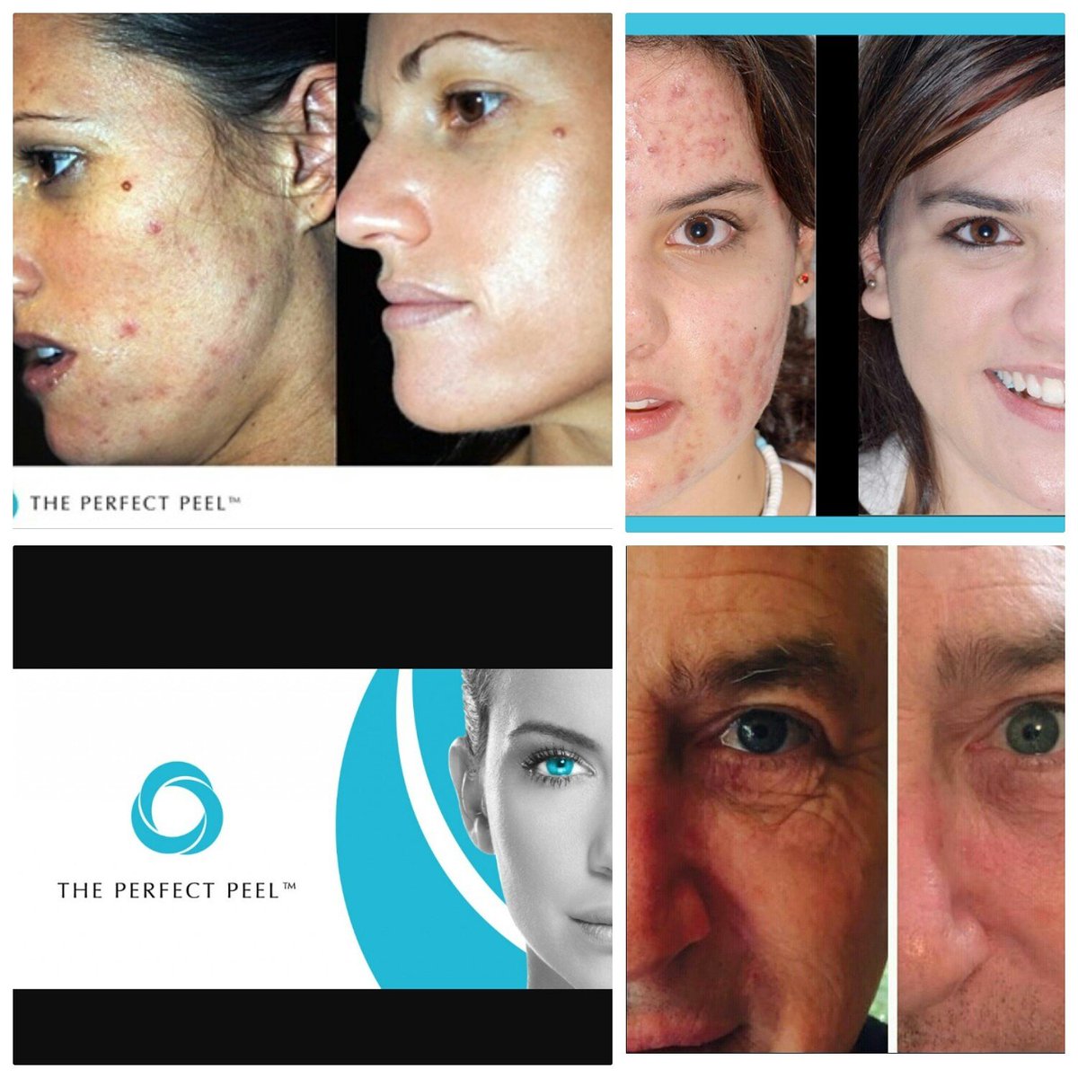 SkinSculpt's tweet photo. From the 1st March ⚪ Skin Sculpt Aesthetics will be offering @ThePerfectPeel  #Amazing #Results #Medical #Acne #Scarring #FreshSkin💗 https://t.co/KiP1Jtjrb3