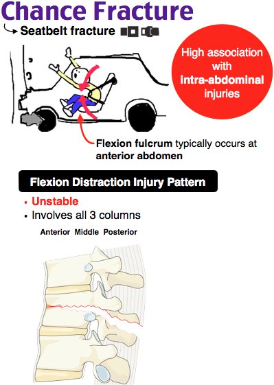 Chance Fracture Seat Belt