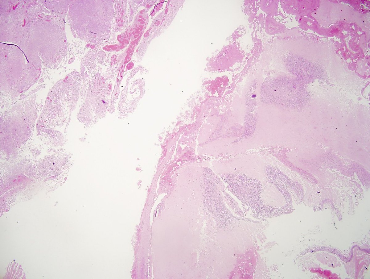 BellaMicheleang's tweet photo. posterior cranial fossa and cerebellum: metastatic squamous cell carcinoma of the cervix, p63, p16 and CK5/6 https://t.co/IpPz5WL2T3