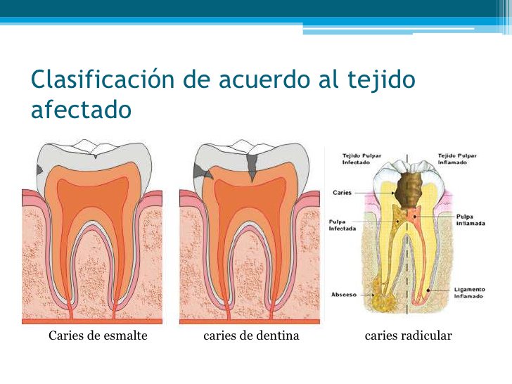 GrupoMandarine's tweet photo. Las #caries son uno de los problemas más graves que afecta a la población mundial. En estado crítico puede hacerte perder el #diente https://t.co/VmY4PtxtBd