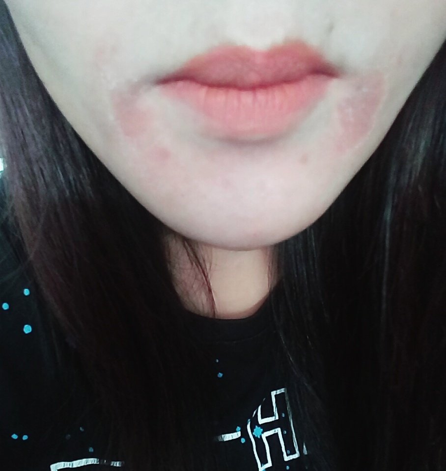 OpieeLuffShaa's tweet photo. Between the mouth pain from the dentist and the allergic reaction I have on my face I feel pretty crappy and just wanna snuggle up in bed😭😭😭 https://t.co/Om6GYlHpBZ