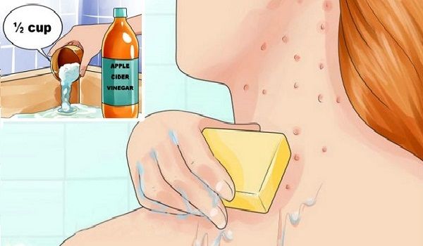 williamhill_1's tweet photo. Put apple cider vinegar on your face and expect a miracle! #AppleCiderVinegar #beauty #beautytips via @naturalnfit https://t.co/4gqsckRGCl https://t.co/1h3tKnZeY6