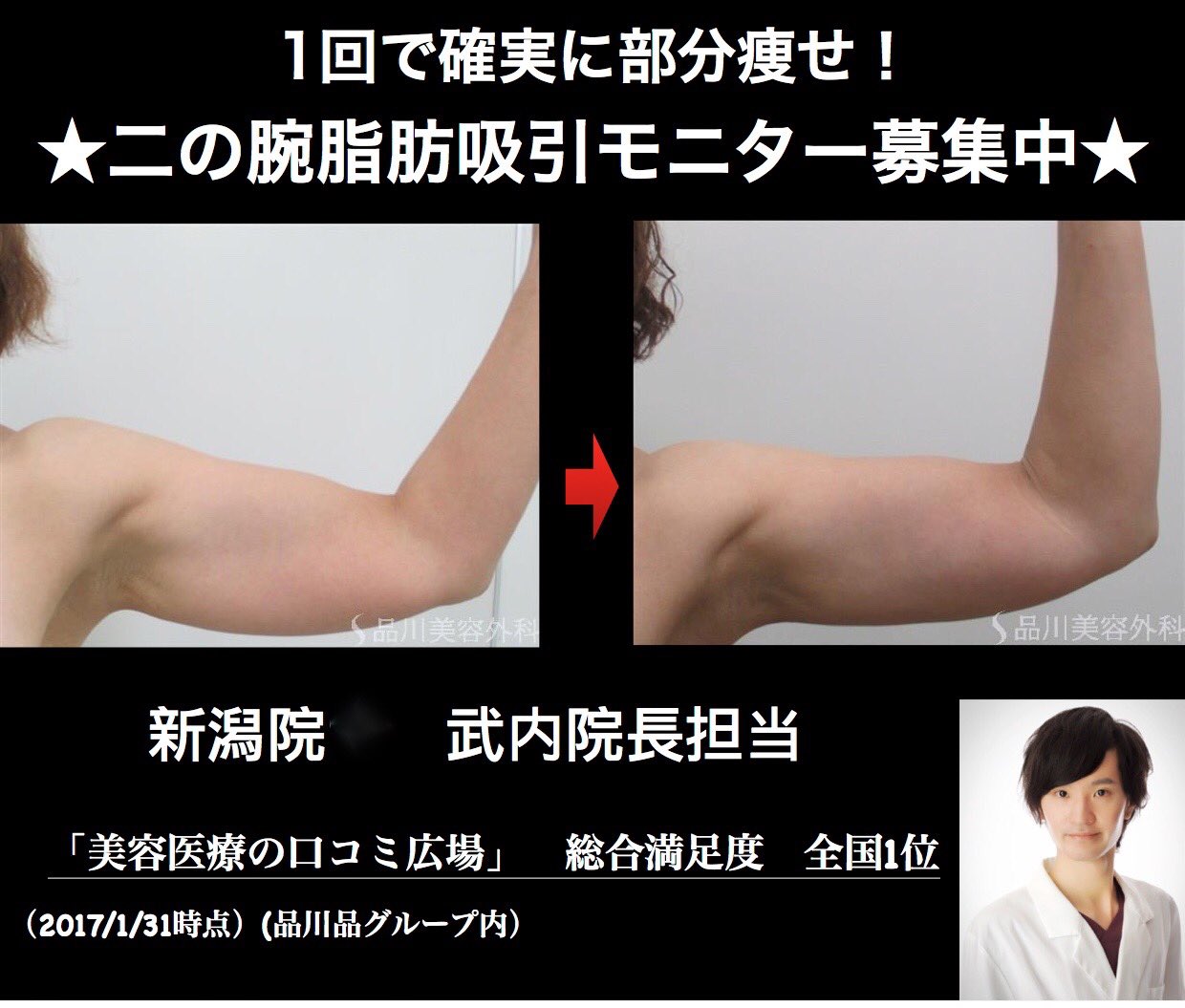糸リフト 二重整形 鼻整形 ルラ美容クリニック院長 武内大 בטוויטר 二の腕脂肪吸引モニター募集 1回で確実に二の腕を細くできます モニター募集中です 興味のある方はお気軽にお問い合わせ下さい 脂肪吸引 二の腕やせ 二の腕脂肪吸引 新潟脂肪吸引