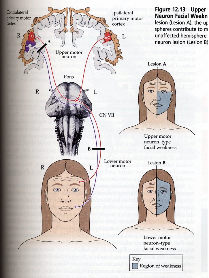 USCDPTdan's tweet photo. Help with diff Dx of UMN v LMN for facial paralysis: Partial? Think UMN! Full? Think LMN!  #546wk5 https://t.co/9Mk25GT4rd