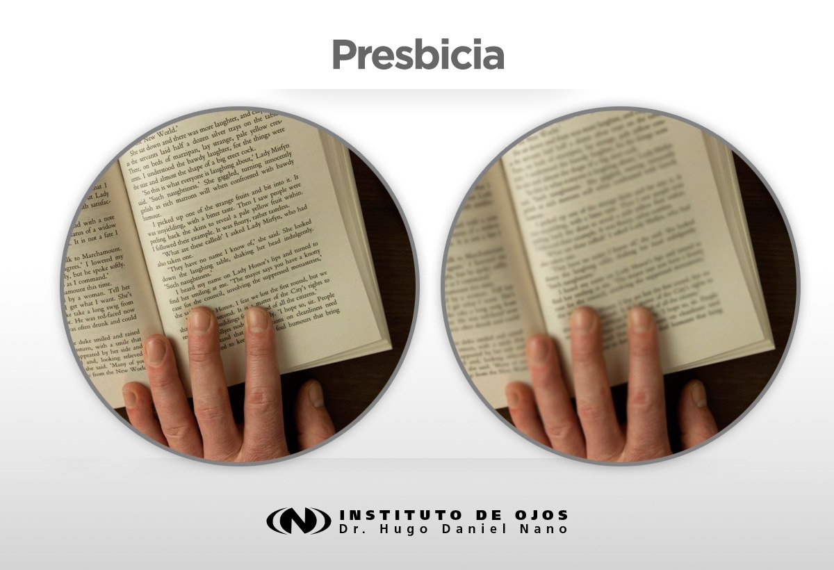 instituto_nano's tweet photo. #Tratamientos #Presbicia La técnica Lasik permite evitar el uso de cuchillos y el contacto manual,logrando una cirugía 100% láser. https://t.co/PjOB9m7BiL