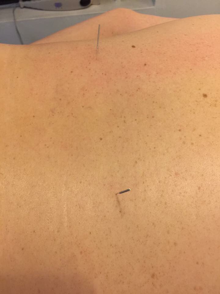demech_salud's tweet photo. Tratamiento dolor lumbar con masaje y acupuntura (V40 y V52) https://t.co/TG5Hhxk4xG