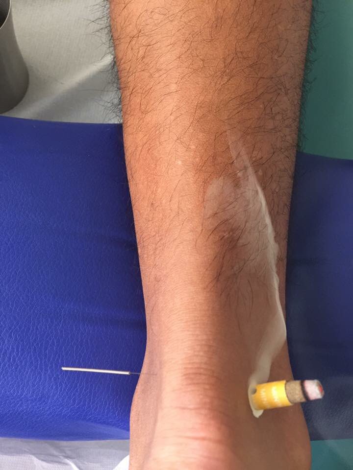demech_salud's tweet photo. Tratamiento para tendinitis con acupuntura + moxa + masaje. 💪💪💪 vamos con todo https://t.co/q7RWTsJLxr