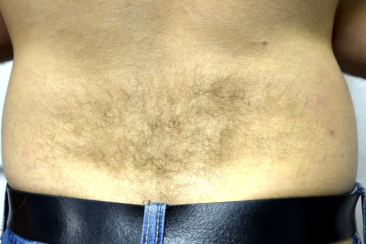 BTLAestheticsUK's tweet photo. Look at how much hair has disappeared This is using the #BTLExilite for #hairremoval it can also be used for #skinrejuvention #acnereduction https://t.co/zkXVgFmbvd