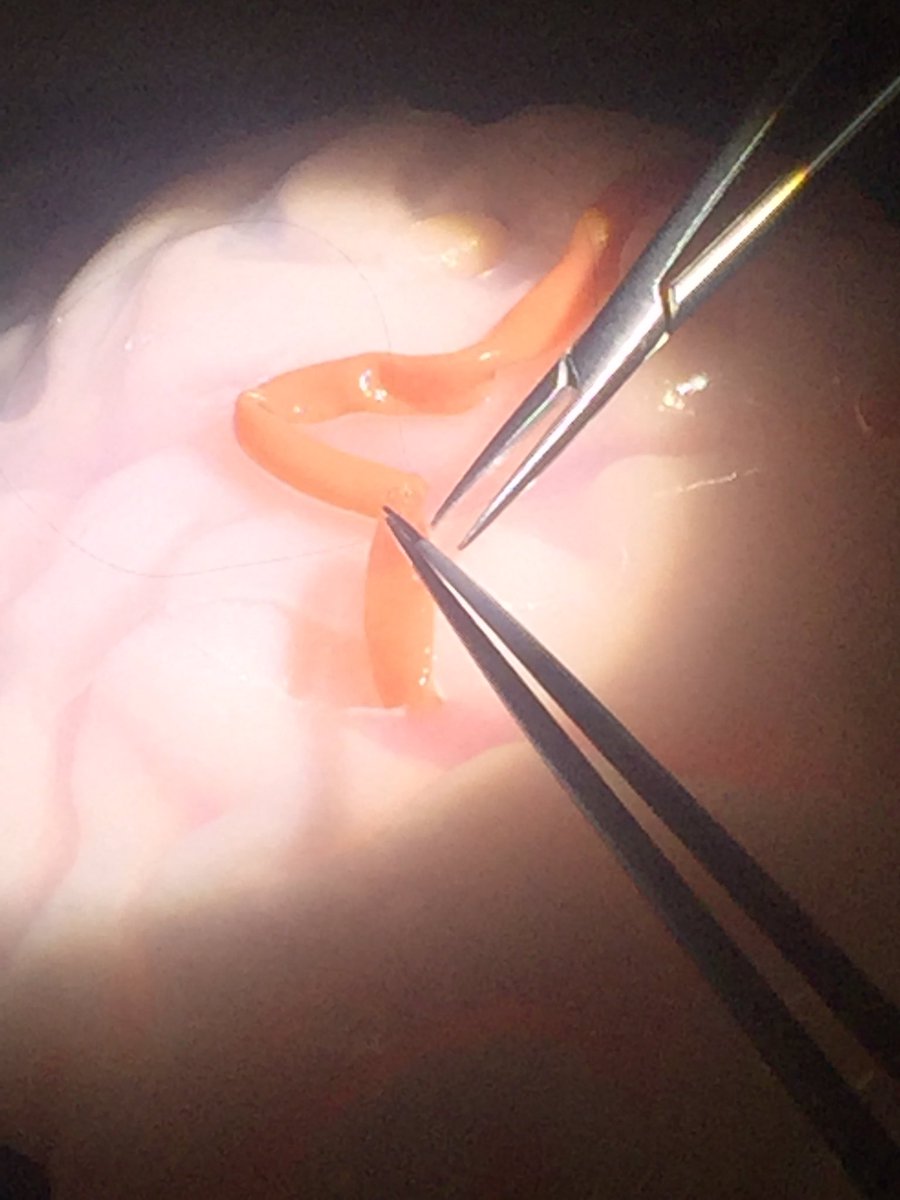 BrainSimulator's tweet photo. Performing an end-to-end anastomosis with #BrightMatter #Simulate #meded https://t.co/wO5UARHVbp