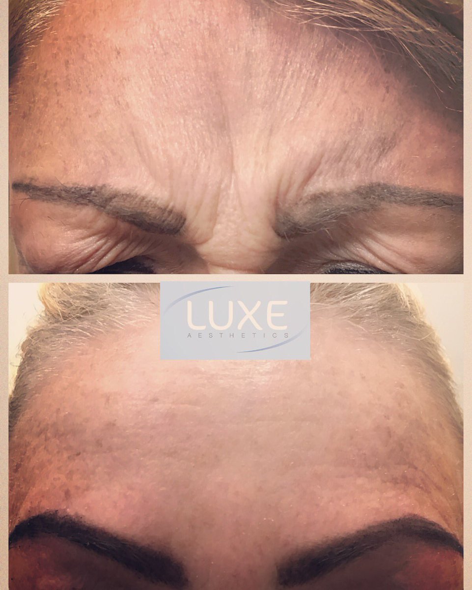 luxeaesthetics's tweet photo. My client wanted reduce lines when frowning and create a brow lift, a small amount of toxin added to get great results👌💉 @luxeaesthetics https://t.co/K8dXuL9qxj