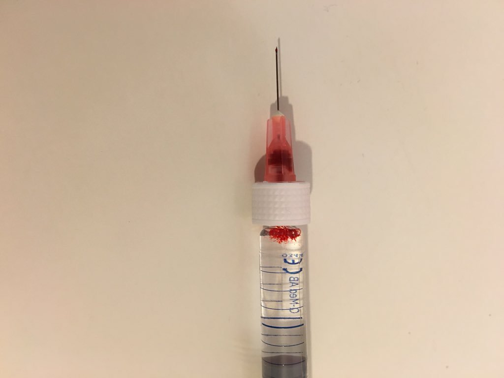 cosmeticdrmark's tweet photo. @Dr_AskariT this happened to me a few months ago. You must aspirate before injecting! No harm came to anyone because danger was anticipated! https://t.co/1HDLr8mV5q