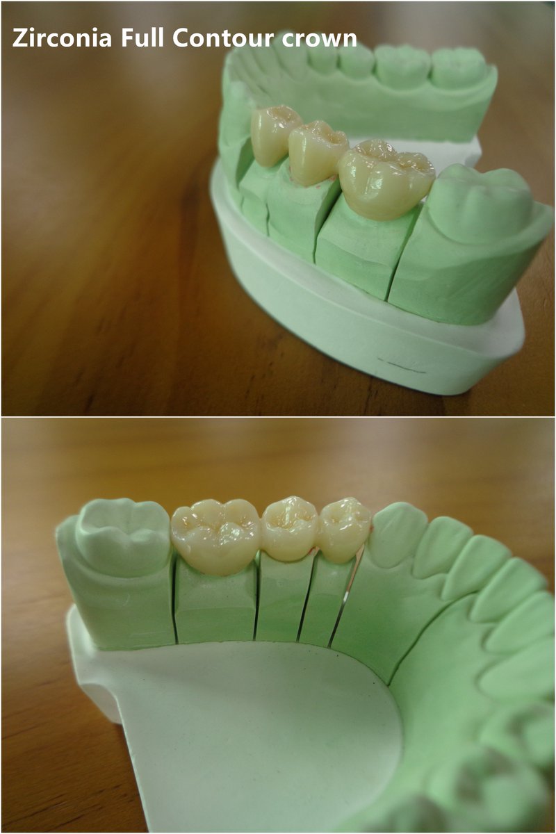 Shane380750926's tweet photo. @Corsa_Ortho # Denture#
# Crown# 
# Sunrise Dental Laboratory in Hong Kong #
Welcome to email 
# shane@sunrisedentallab.com.hk # for a price https://t.co/q9RwSgFl5H