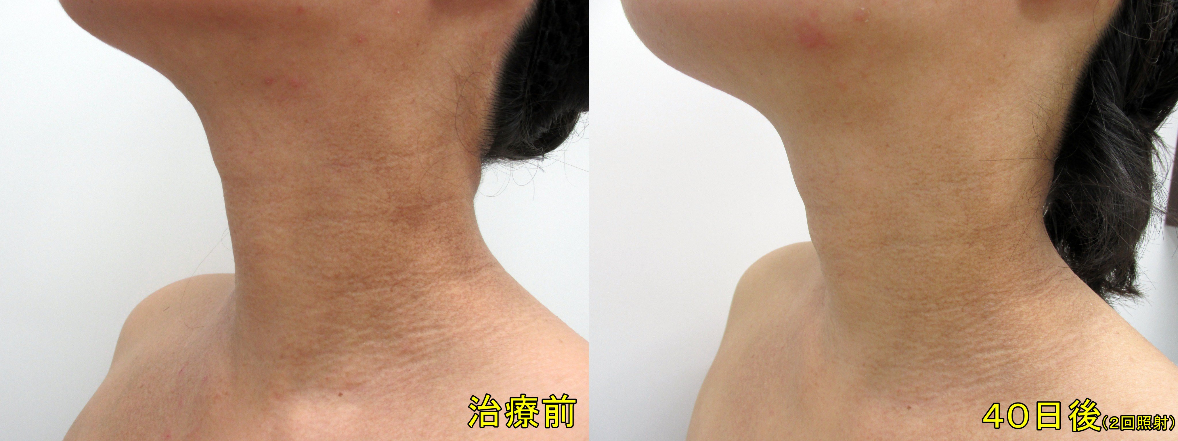 橋本院長 スキンフィニティクリニック アトピー性皮膚炎後の首の色素沈着でお悩みの方には 当院では積極的に治療を行っております この症状に加える治療は 皮膚炎症状をぶり返すリスクが少ないことが必須です 黒ずみ 質感ともに改善しています