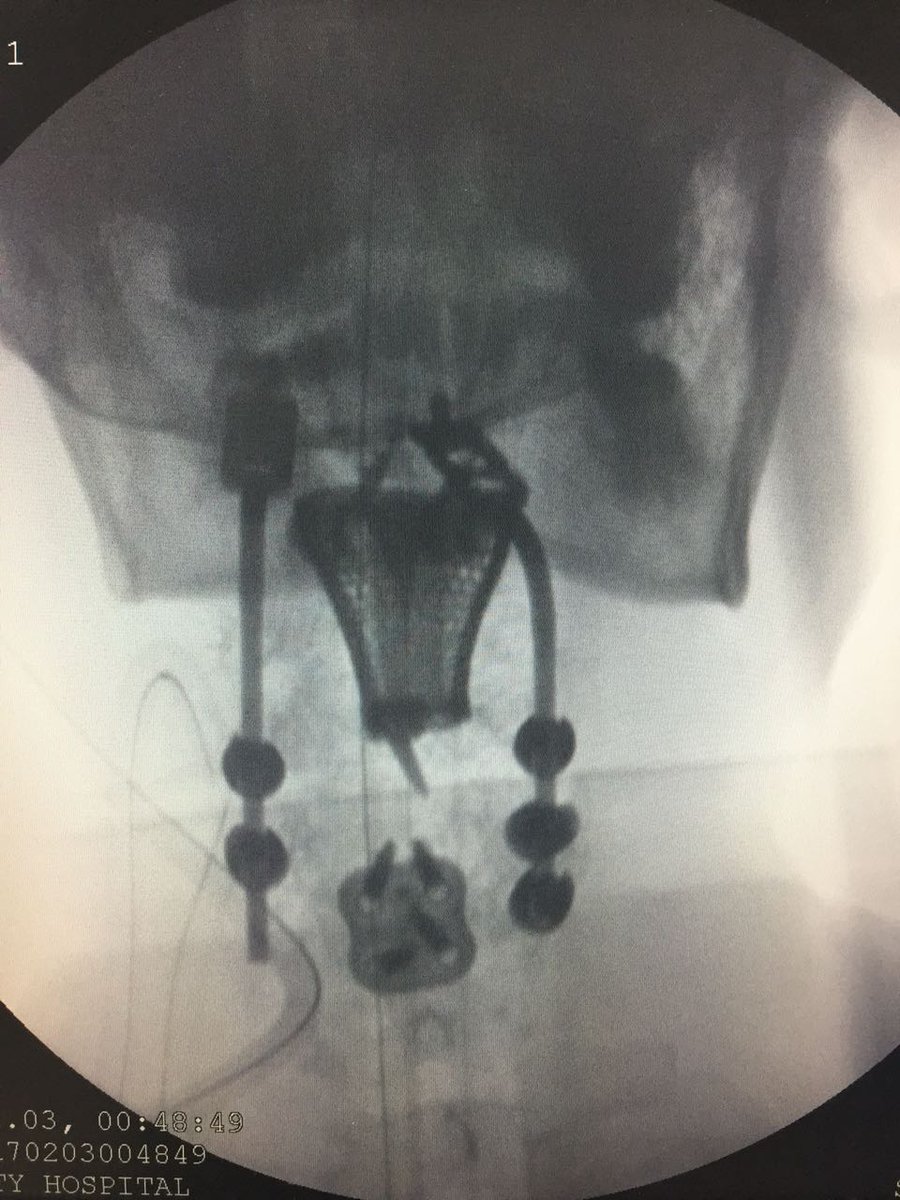 3DPrint_com's tweet photo. For the First Time in India, #3DPrinted Titanium Vertebrae Restore a Woman's Damaged Spine
https://t.co/98x8mDm3Zl
#3Dprinting https://t.co/NQ8tlPMUdn