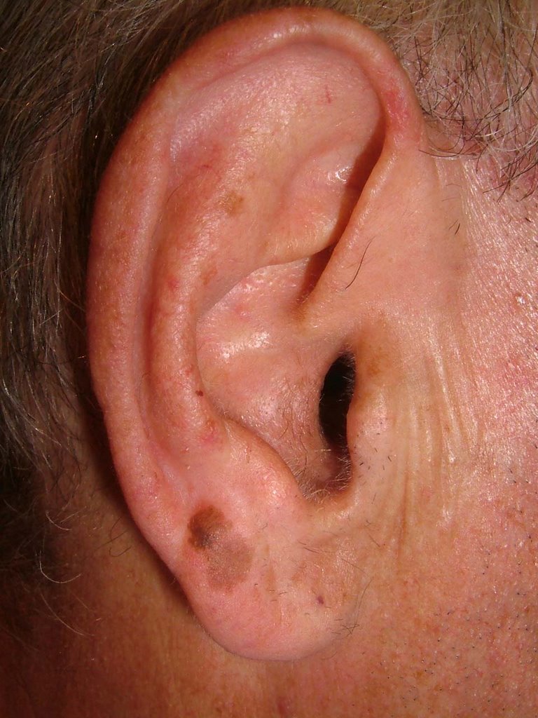 leninsmo11's tweet photo. Dr #Rendon center offers #Mohs #micrographic surgery as a #skin care treatment to all their South #Florida patients.https://t.co/rJQJH17aE7 https://t.co/AzseIrDAXu