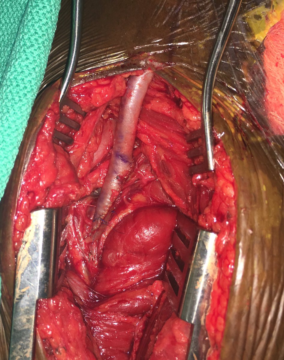 BruceTjadenMD's tweet photo. #OpenBypass to the deep femoral artery for #CriticalLimbIschemia. (@UTCVSurgery) (@iotepozee) https://t.co/sT0lMEshDD