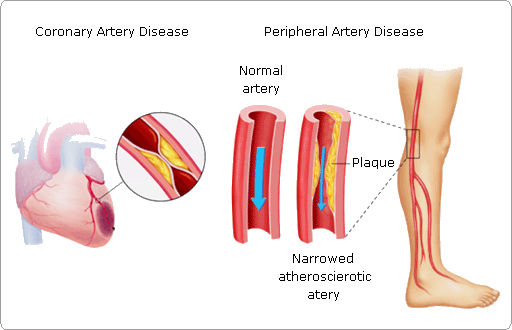 Ишемия конечностей симптомы. Тромбоз артериальных сосудов. Артериальный тромбоз конечностей. Тромбоз и эмболия и атеросклероз. Эмболия сосудов конечностей.