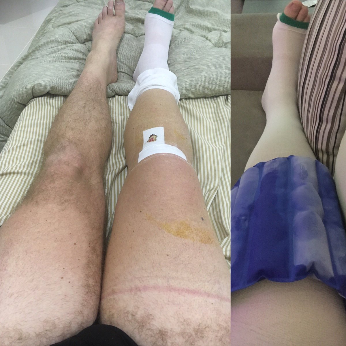 LevettSimon's tweet photo. Day 9 Post op.Leg still massive,so keep on icing. @ACLSupport @ACLrecoveryCLUB Had 1st physio session,hard work will win. #EndGoal #LongRd https://t.co/I4rWkP8UHw